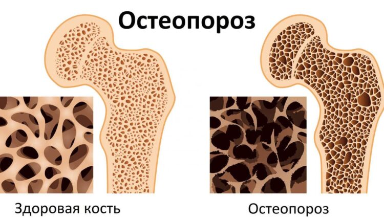 Как защитить кости от старения – правильная еда